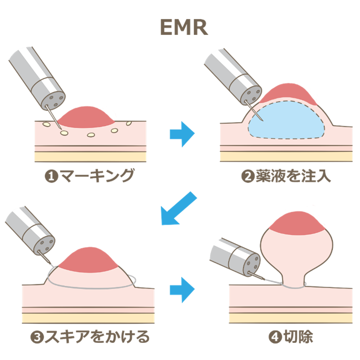 ① 内視鏡的粘膜切除術（Endoscopic mucosal resection：ＥＭＲ）